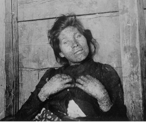 Woman infected with smallpox. Image: Library and Archives Canada: In Quarantine: Life and Death on Grosse Ile.